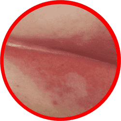 rash on buttocks crack yeast